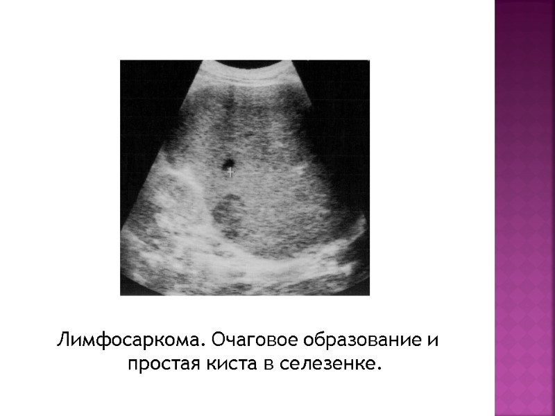 Лимфосаркома. Очаговое образование и простая киста в селезенке.
